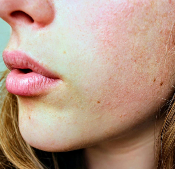 Rosacea